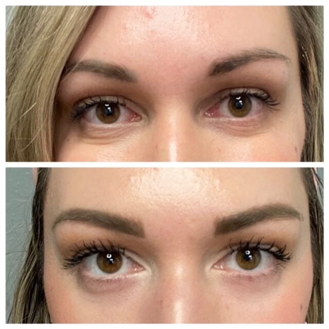 AnteAGE MD Eye stem cell-based eye cream with growth factors, peptides, before and after image showing smoother lines and brighten skin