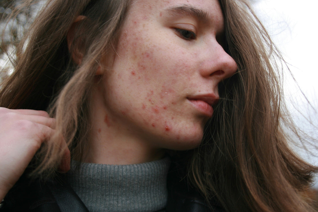 Woman’s face showing skin congestion and acne